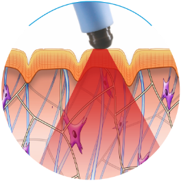 during_exilis